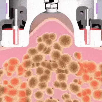 Cupnova 12 levels – Anti-Cellulite Massagegerät für schnelle Ergebnisse - Image 12