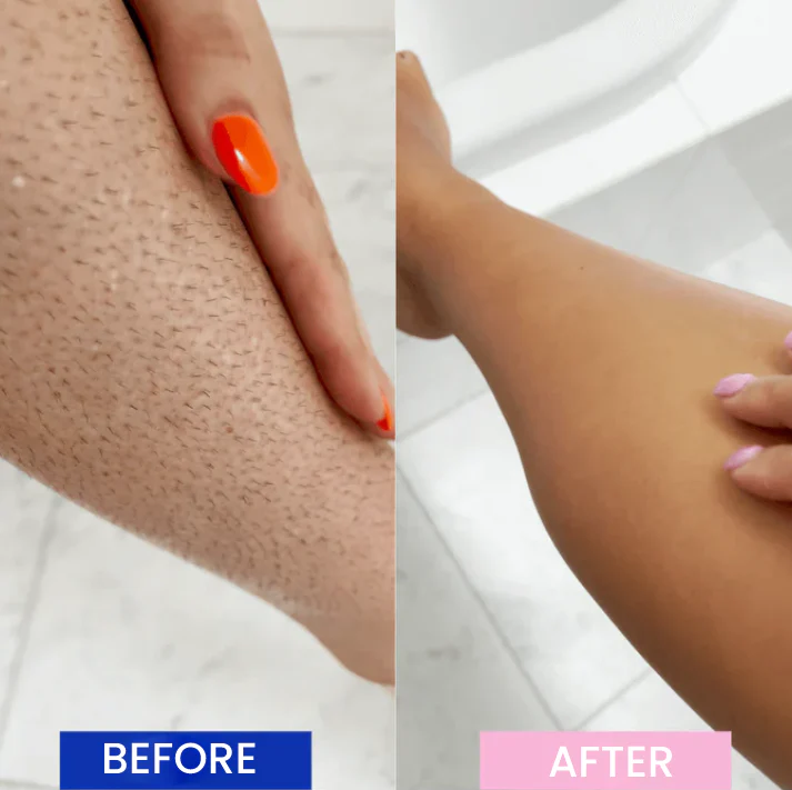 GlowFree – Schmerzfreie Laser-Haarentfernung für dauerhaft seidenglatte Haut | 50% RABATT - Image 5