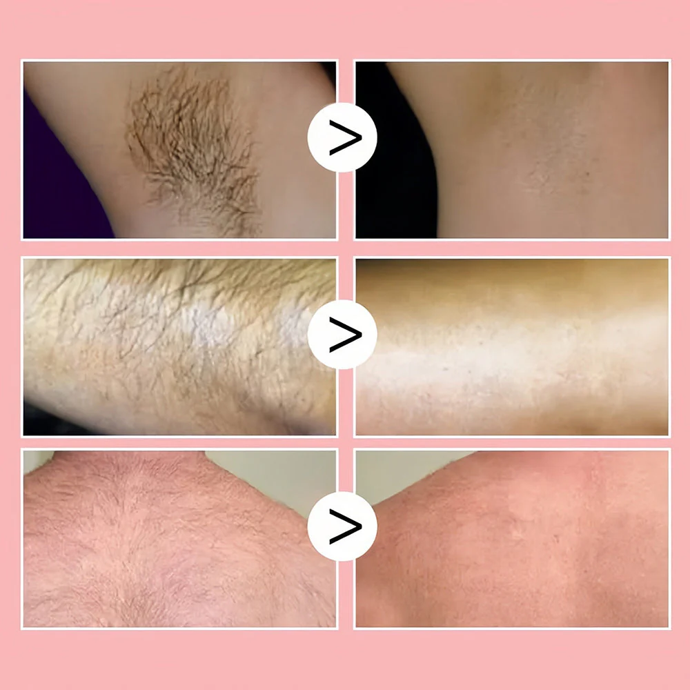 1+1 GRATIS | 100ml Honey Mousse Hair Removal Spray™ – Für eine makellose und haarfreie Haut! - Image 3