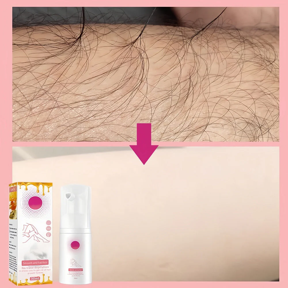 1+1 GRATIS | 100ml Honey Mousse Hair Removal Spray™ – Für eine makellose und haarfreie Haut! - Image 5